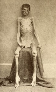 Union POW of Andersonville